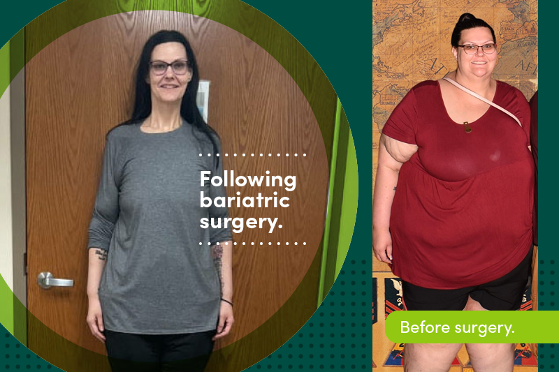 Stacey Peterson before and after bariatric surgery